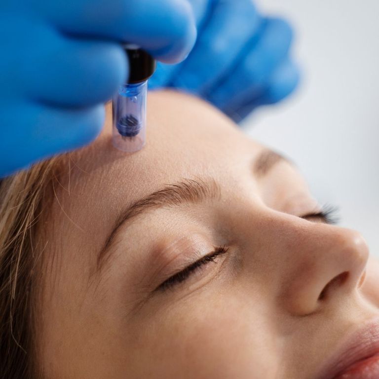 Microneedling – Wirkung, Ablauf und was es bringt Microneedling – Wirkung, Ablauf und was es bringt
